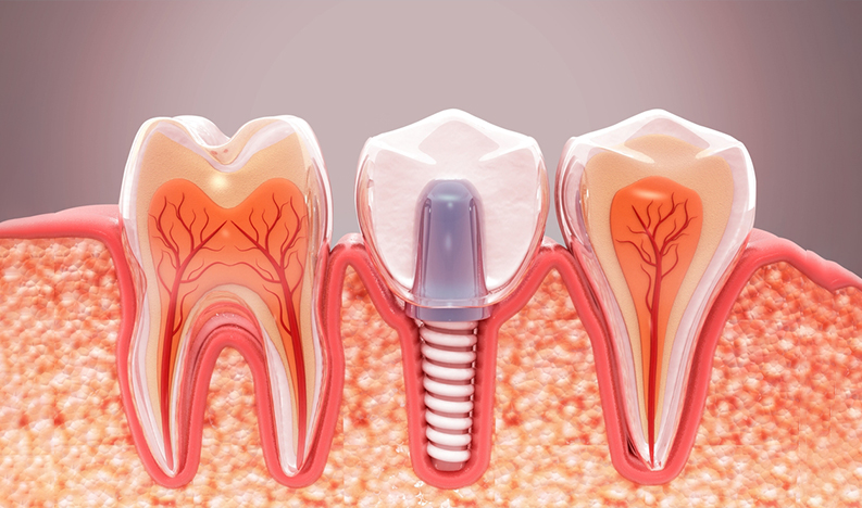 service-Implant service-Implant